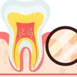 5 Frequently Asked Questions for Baby Root Canal in Toronto