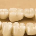 When Is The Best Time To Get Dental Bridges?