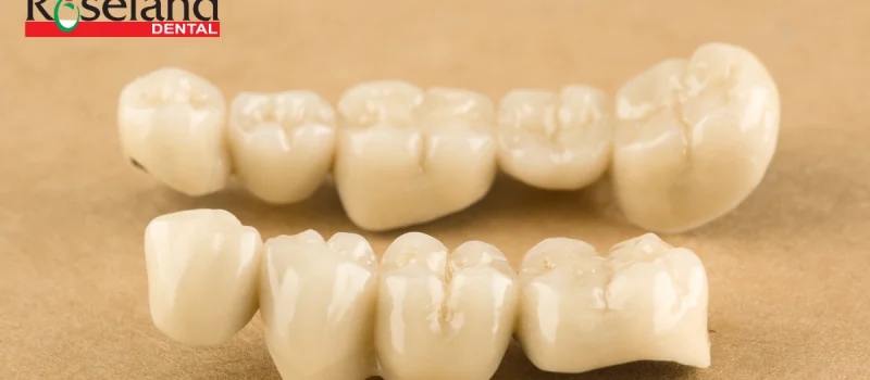 When Is The Best Time To Get Dental Bridges?