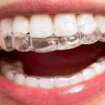 10 Tips On How To Get The Most Of Invisalign