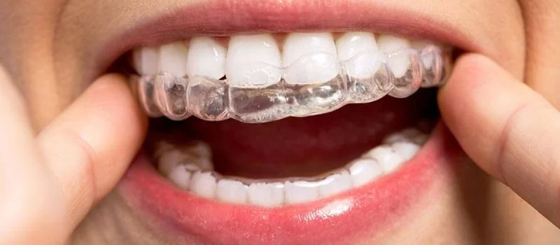 10 Tips On How To Get The Most Of Invisalign
