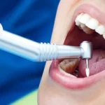 A Comprehensive Guide To Understanding Root Canal