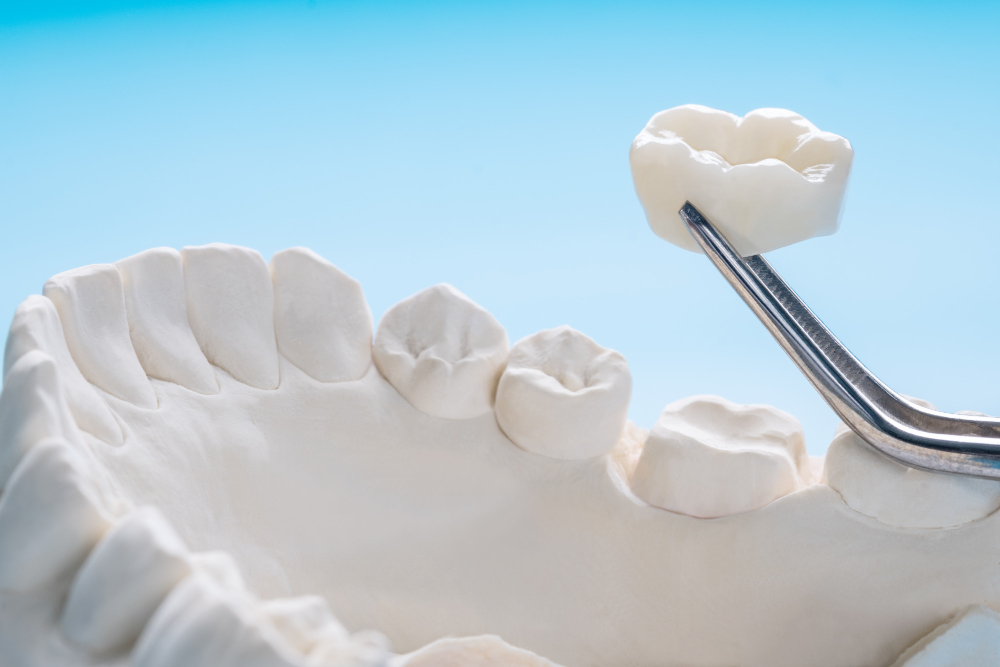 Dental Crowns vs Dental Bridges: Understanding the Difference
