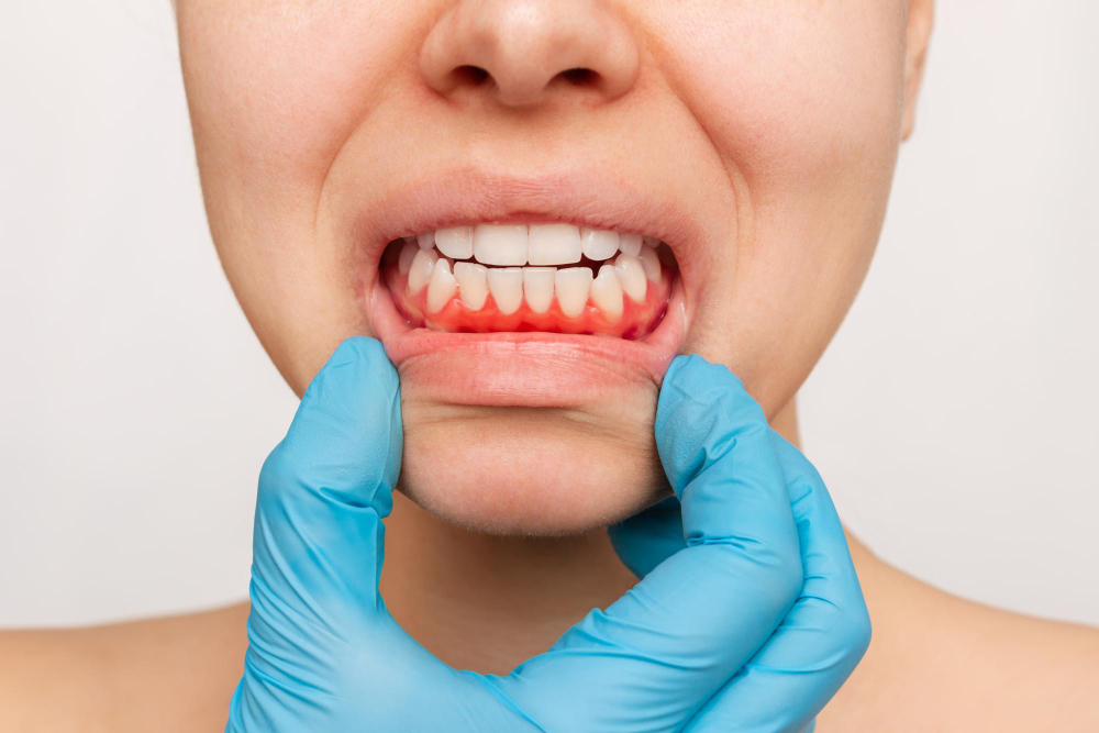 Why Are My Gums Bleeding? Common Causes and What to Do Next