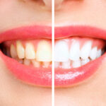 teeth whitening Toronto