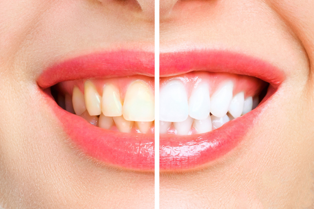 Teeth Whitening in Toronto: Professional Treatment vs At-Home Kits