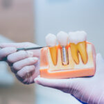 dental implants Toronto