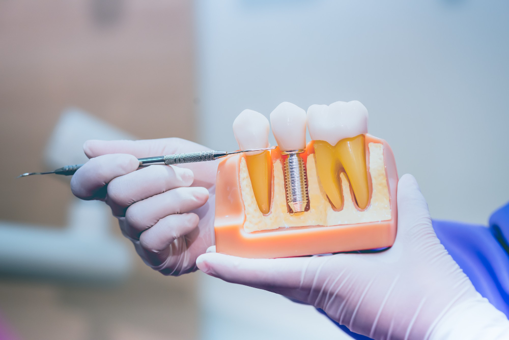 dental implants Toronto
